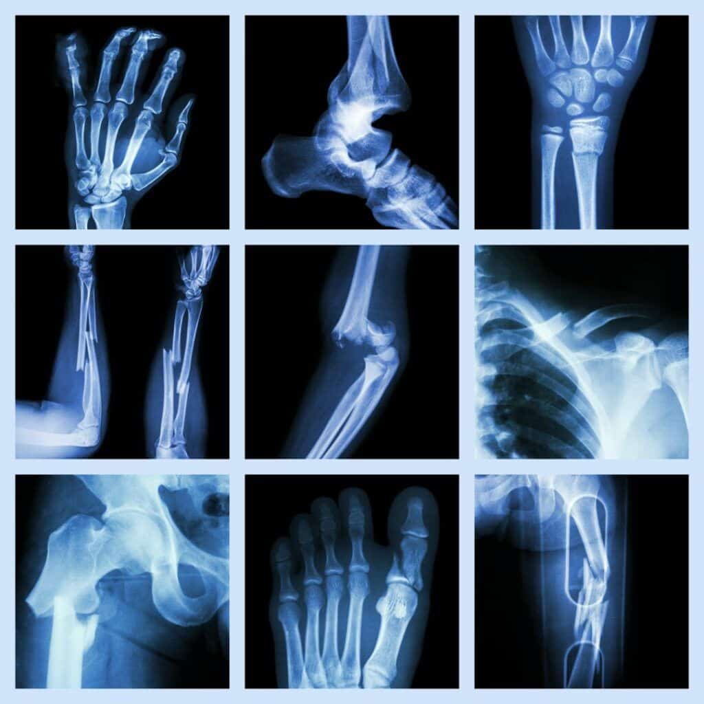Collage aus Röntgenaufnahmen von menschlichen Gelenken und Knochen