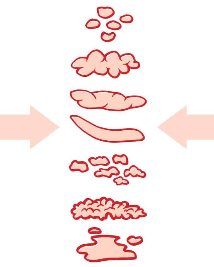 bristol stool chart Formen von Stuhlgang