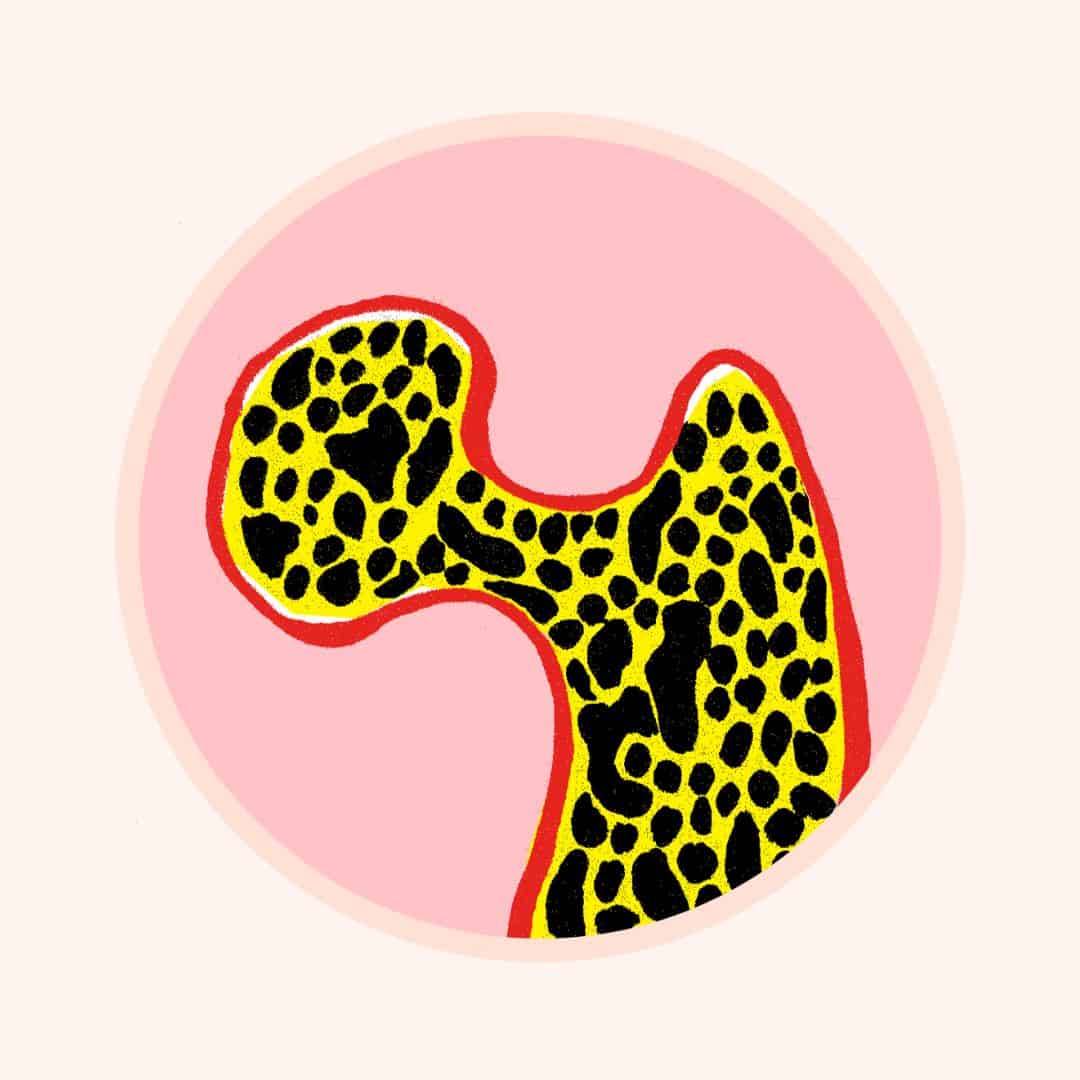 Osteoperose _ Illustration_ Anja von Bodecker