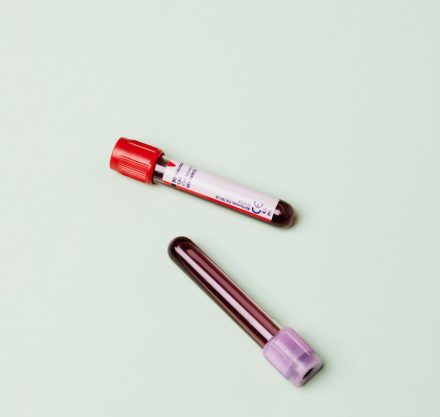 Langzeitzucker Hämoglobin A1c
