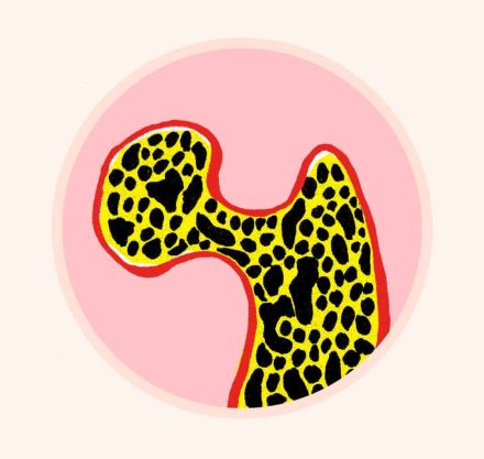 Osteoperose _ Illustration_ Anja von Bodecker
